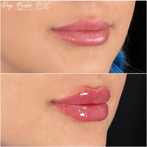 Lip Augmentation by Flawless Medspa