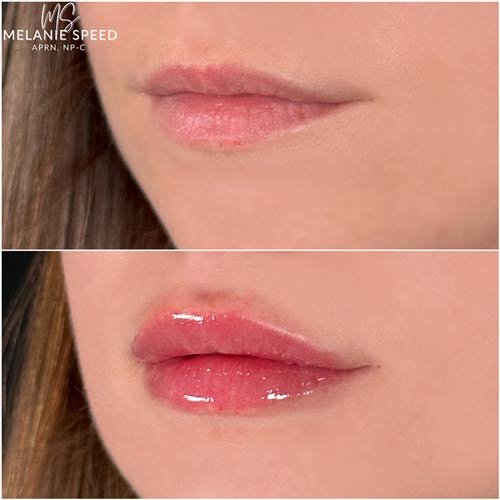 Lip Augmentation by Flawless Medspa