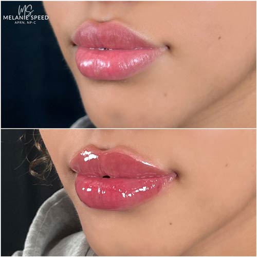 Lip Augmentation by Flawless Medspa