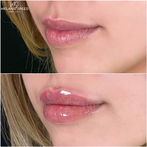 Lip Augmentation by Flawless Medspa