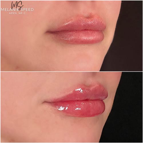 Lip Augmentation by Flawless Medspa