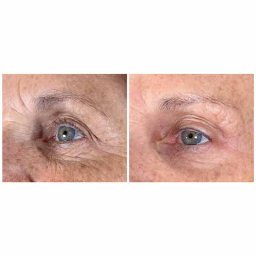 Scarlet SRF Treatment Specialist Near Me in Las Vegas, NV Scarlet SRF Treatment Specialist Near Me in Las Vegas, NV