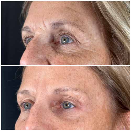 Scarlet SRF Treatment Specialist Near Me in Las Vegas, NV Scarlet SRF Treatment Specialist Near Me in Las Vegas, NV