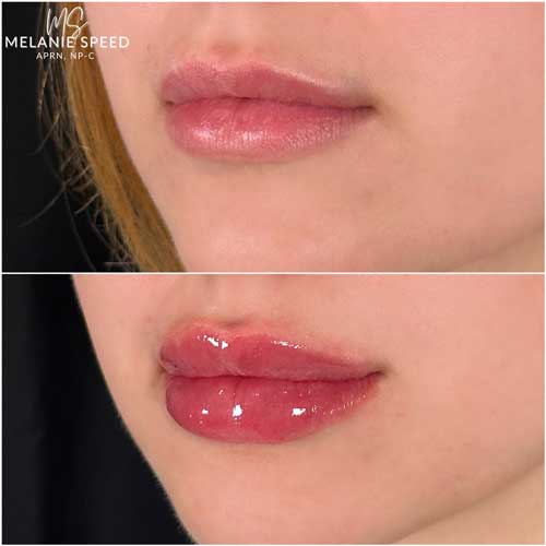 Lip Augmentation by Flawless Medspa