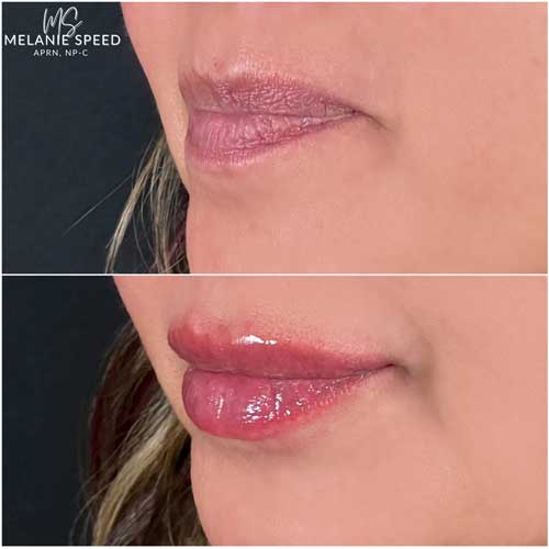 Lip Augmentation by Flawless Medspa