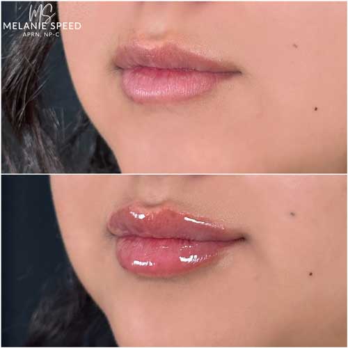 Lip Augmentation by Flawless Medspa