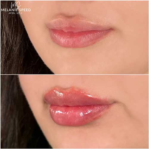 Lip Augmentation by Flawless Medspa