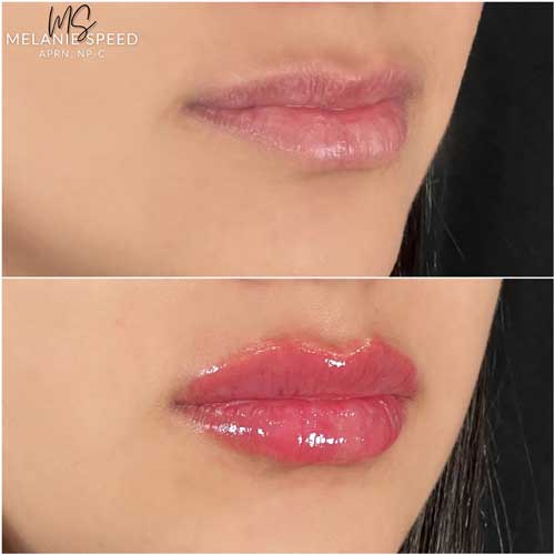 Lip Augmentation by Flawless Medspa