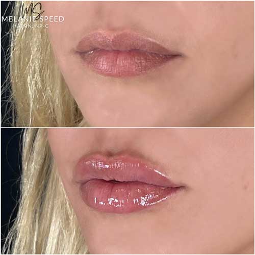 Lip Augmentation by Flawless Medspa