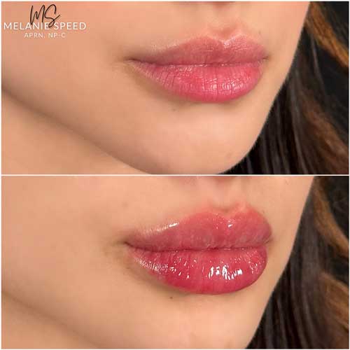 Lip Augmentation by Flawless Medspa