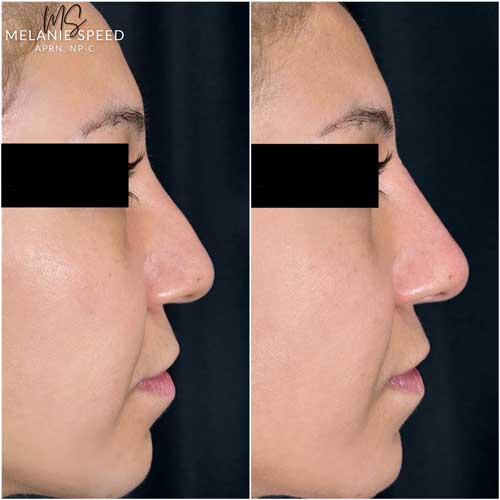 Nose Correction by Flawless Medspa