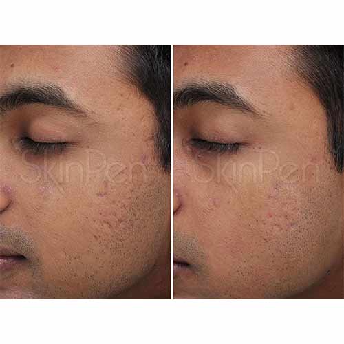 Skin Facial Rejuvenation by Flawless Medspa