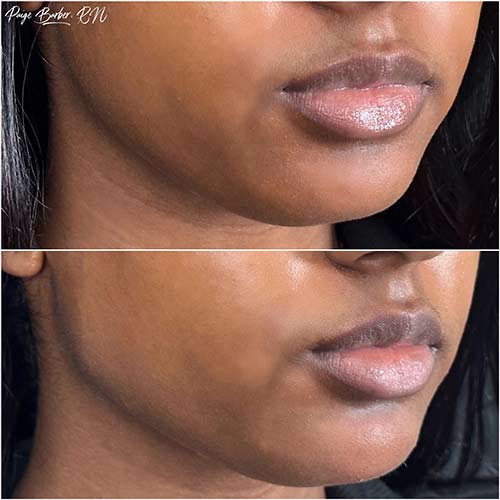 Chin & Jawline Correction by Flawless Medspa