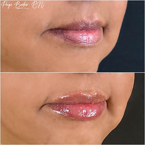 Lip Injections Before and After at Flawless MedSpa & The Beverly Hills MedSpa in Beverly Hills, CA and Las Vegas, NV Lip Injections Before and After at Flawless MedSpa & The Beverly Hills MedSpa in Beverly Hills, CA and Las Vegas, NV