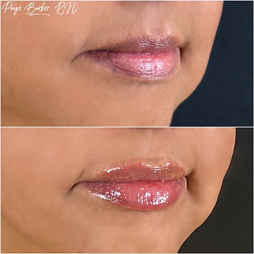 Lip Augmentation by Flawless Medspa