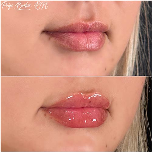 Lip Augmentation by Flawless Medspa