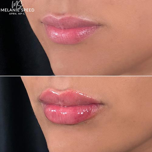 Lip Augmentation by Flawless Medspa