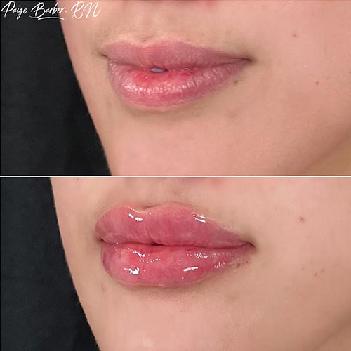 Lip Augmentation by Flawless Medspa