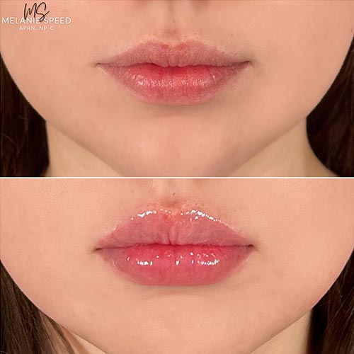 Lip Augmentation by Flawless Medspa