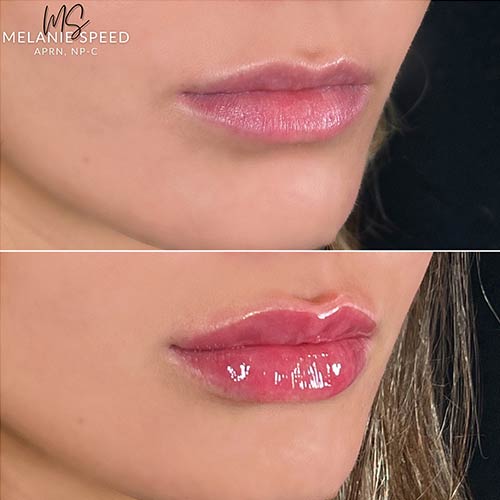 Lip Augmentation by Flawless Medspa