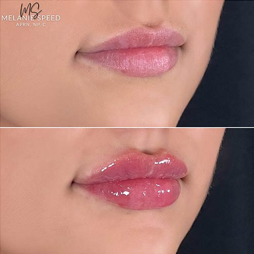 Lip Augmentation by Flawless Medspa