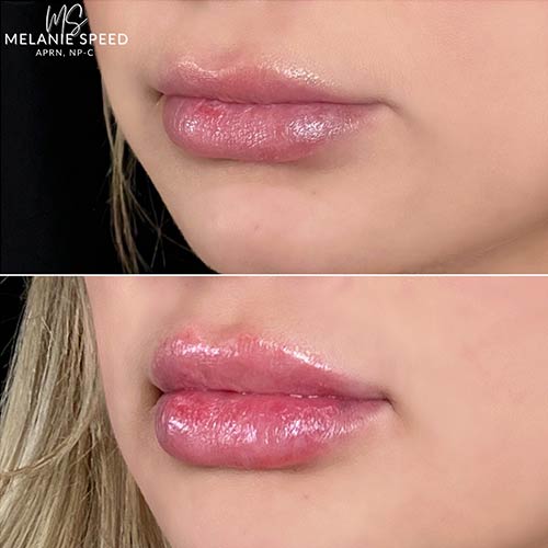 Lip Augmentation by Flawless Medspa