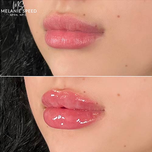 Lip Augmentation by Flawless Medspa