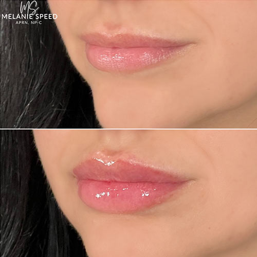 Lip Augmentation by Flawless Medspa