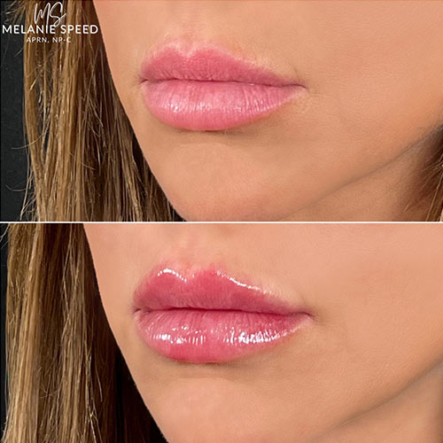 Lip Augmentation by Flawless Medspa