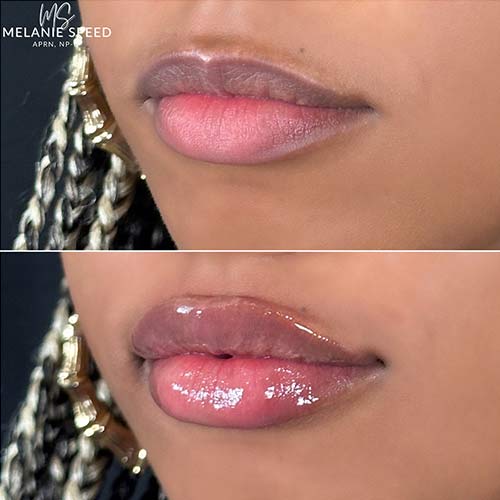 Lip Augmentation by Flawless Medspa