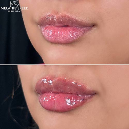 Lip Augmentation by Flawless Medspa