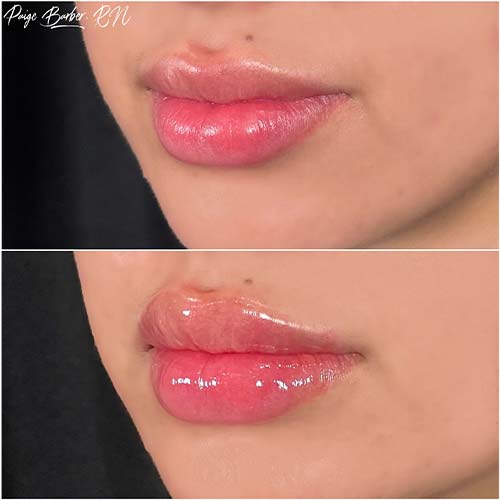 Lip Augmentation by Flawless Medspa