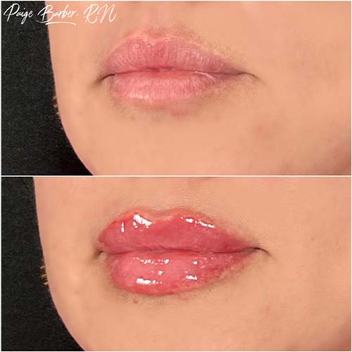 Lip Augmentation by Flawless Medspa