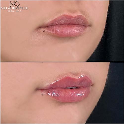 Lip Augmentation by Flawless Medspa