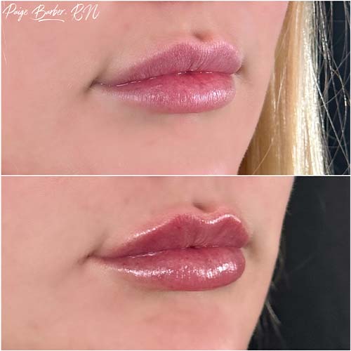 Lip Augmentation by Flawless Medspa