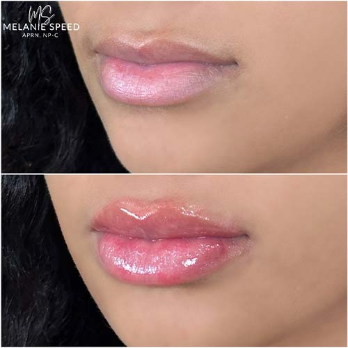 Lip Augmentation by Flawless Medspa