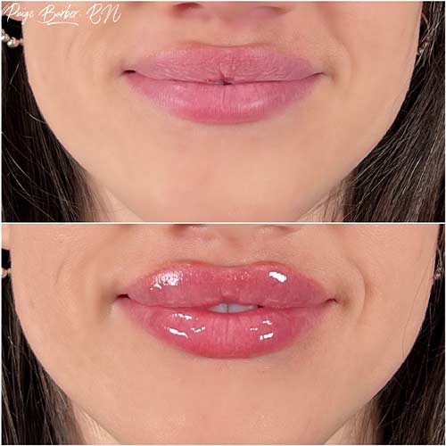 Lip Augmentation by Flawless Medspa