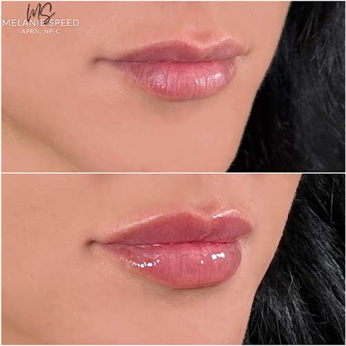 Lip Augmentation by Flawless Medspa