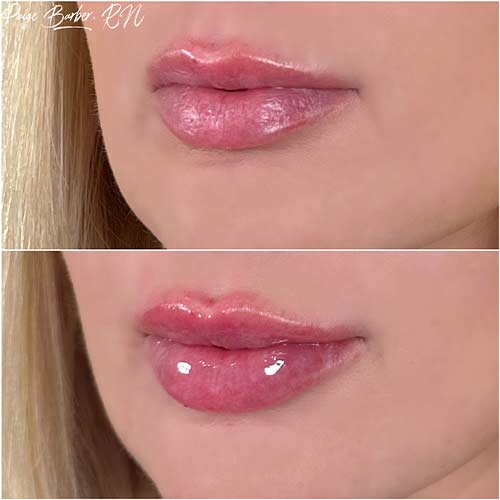 Lip Augmentation by Flawless Medspa