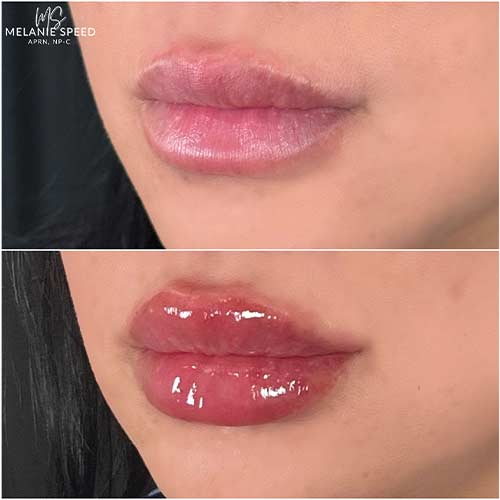 Lip Augmentation by Flawless Medspa