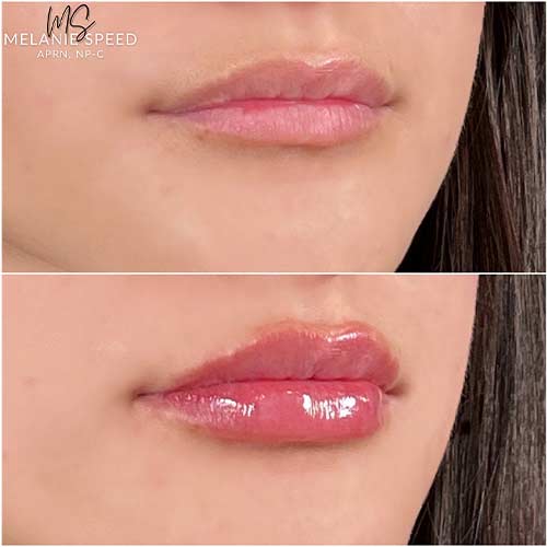 Lip Augmentation by Flawless Medspa