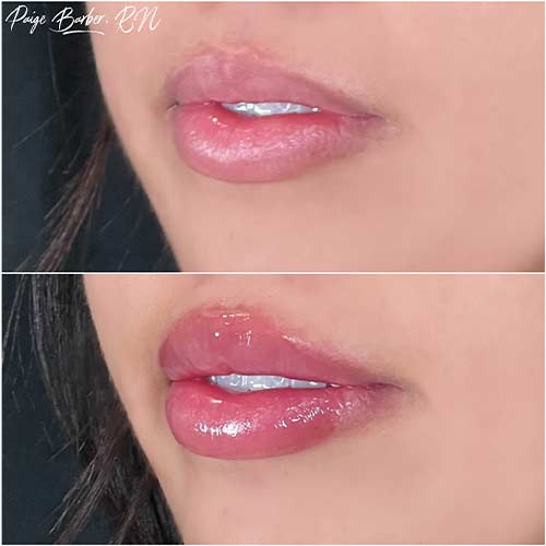 Lip Augmentation by Flawless Medspa