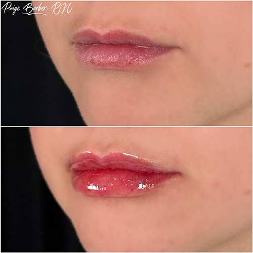 Lip Augmentation by Flawless Medspa