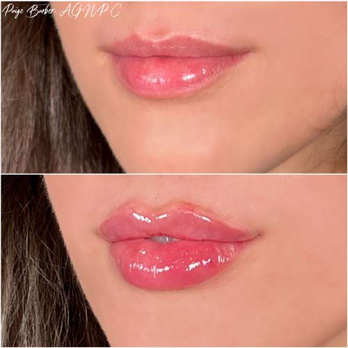 Lip Augmentation by Flawless Medspa