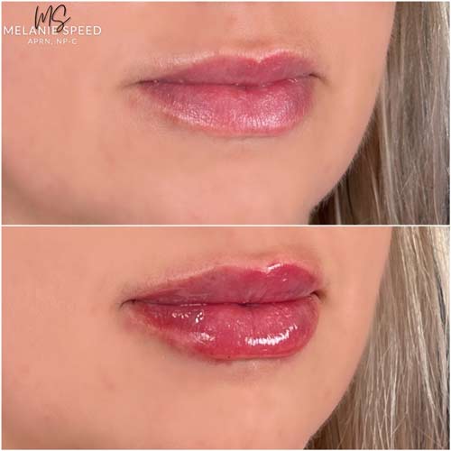 Lip Augmentation by Flawless Medspa