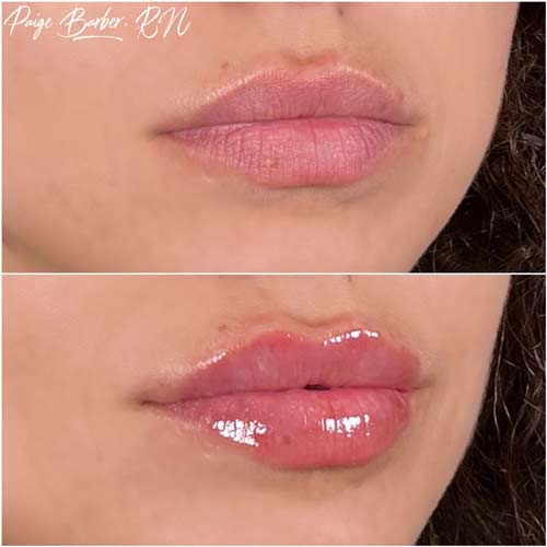 Lip Augmentation by Flawless Medspa