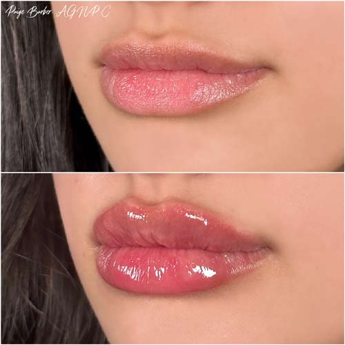 Lip Augmentation by Flawless Medspa