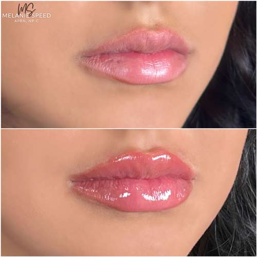 Lip Augmentation by Flawless Medspa