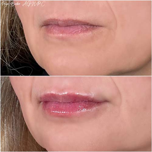 Lip Augmentation by Flawless Medspa