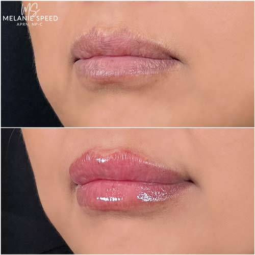 Lip Augmentation by Flawless Medspa